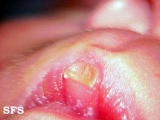 callosities of the lips
