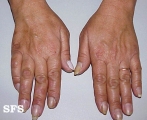 leprosy neural