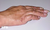 leprosy neural