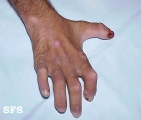 leprosy neural