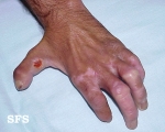 leprosy neural