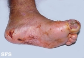 leprosy neural