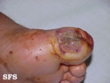 leprosy neural