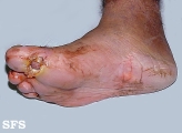 leprosy neural