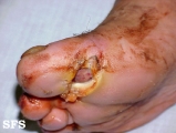 leprosy neural
