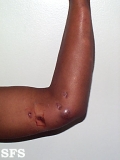leprosy neural