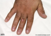 knuckle pads