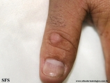 knuckle pads