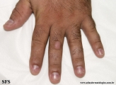 knuckle pads