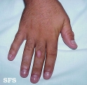 knuckle pads