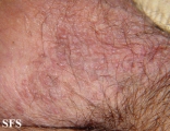 darier-like epidermal naevus