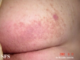 darier-like epidermal naevus