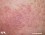 darier-like epidermal naevus