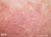 darier-like epidermal naevus