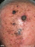 melanoma