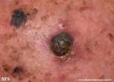 melanoma