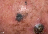 melanoma