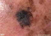 melanoma