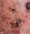 melanoma