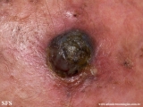 melanoma