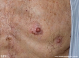 melanoma