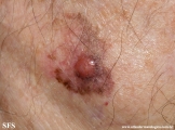 melanoma