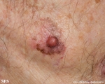 melanoma