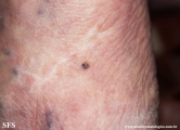 melanoma