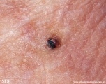 melanoma