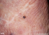 melanoma