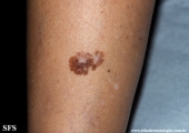 melanoma