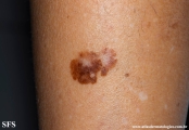 melanoma