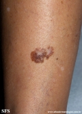 melanoma