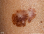 melanoma