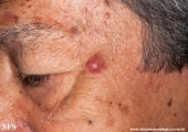 melanoma