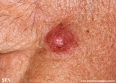 melanoma
