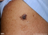 melanoma