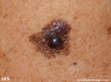 melanoma
