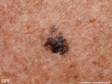 melanoma