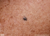 melanoma