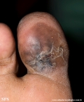 melanoma