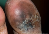 melanoma