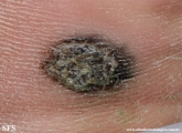 melanoma