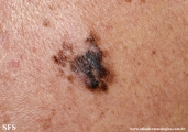 melanoma
