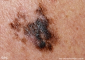 melanoma