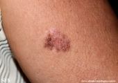 melanoma