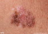 melanoma