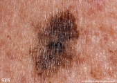 melanoma