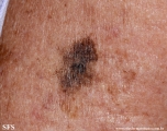 melanoma