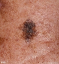 melanoma